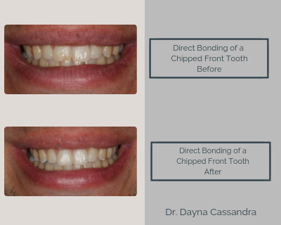 Direct Bonding of a Chipped Front Tooth