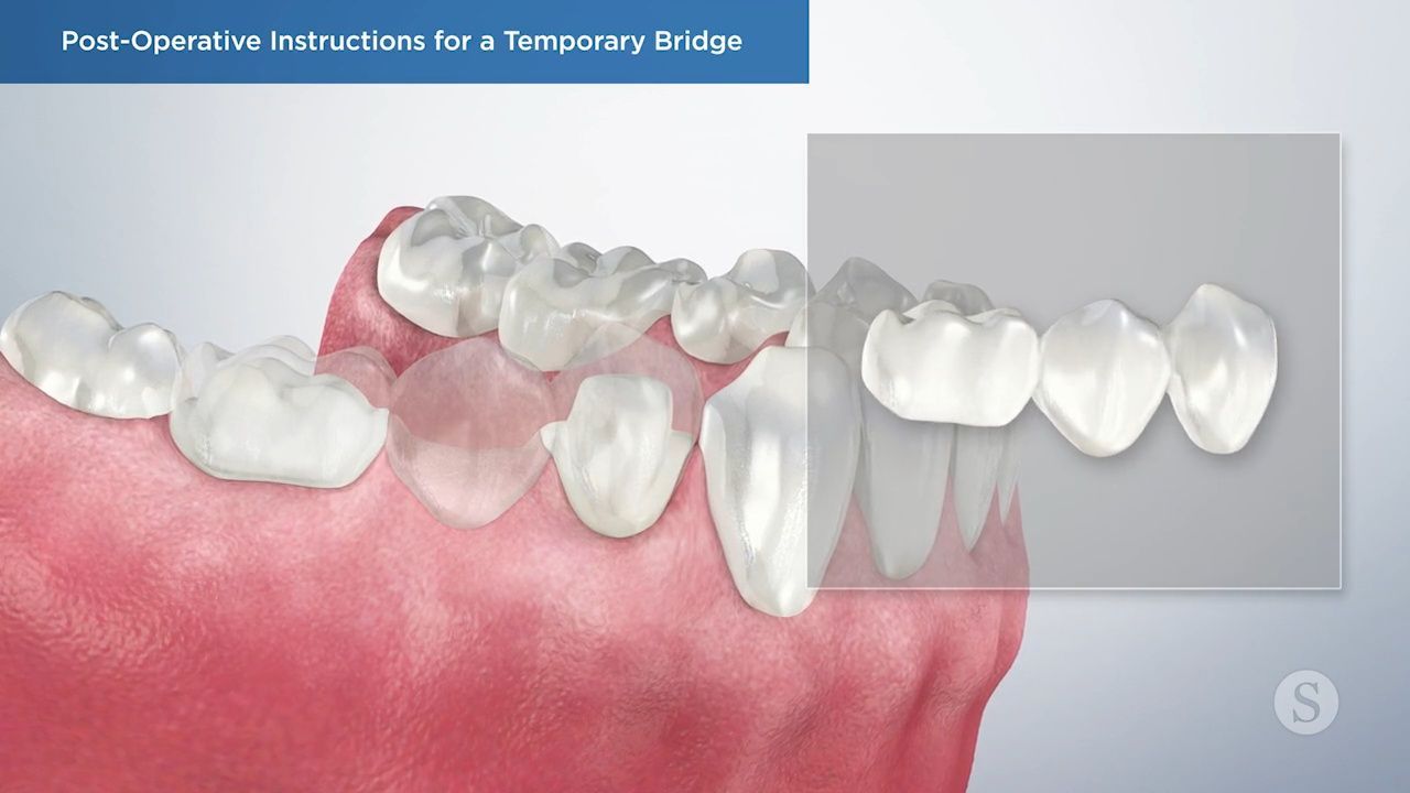 Illustration of proper flossing technique.