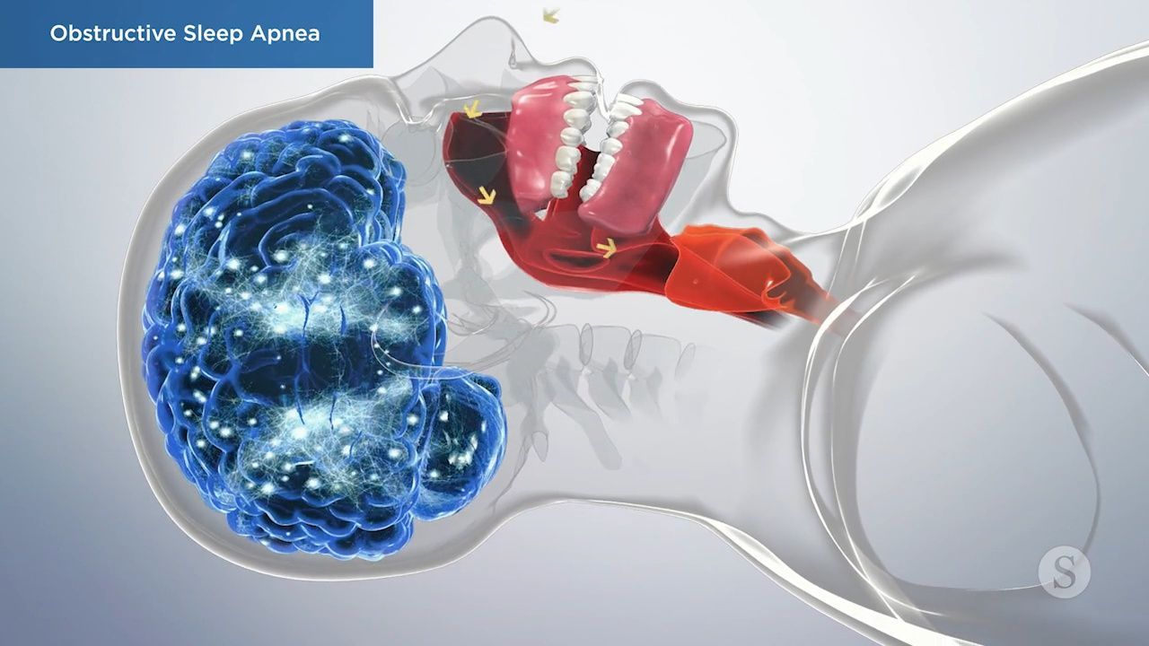 Diagram showing obstructive sleep apnea anatomy.