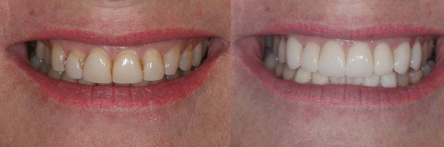 Before and after teeth comparison.