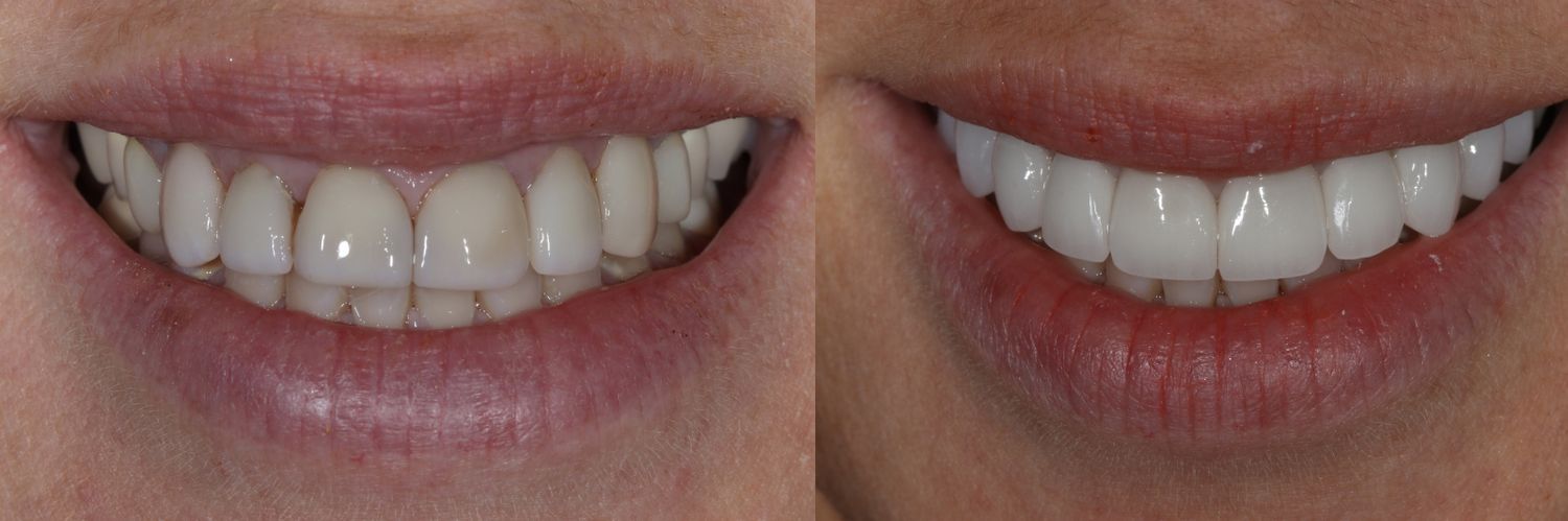 Before and after teeth comparison.