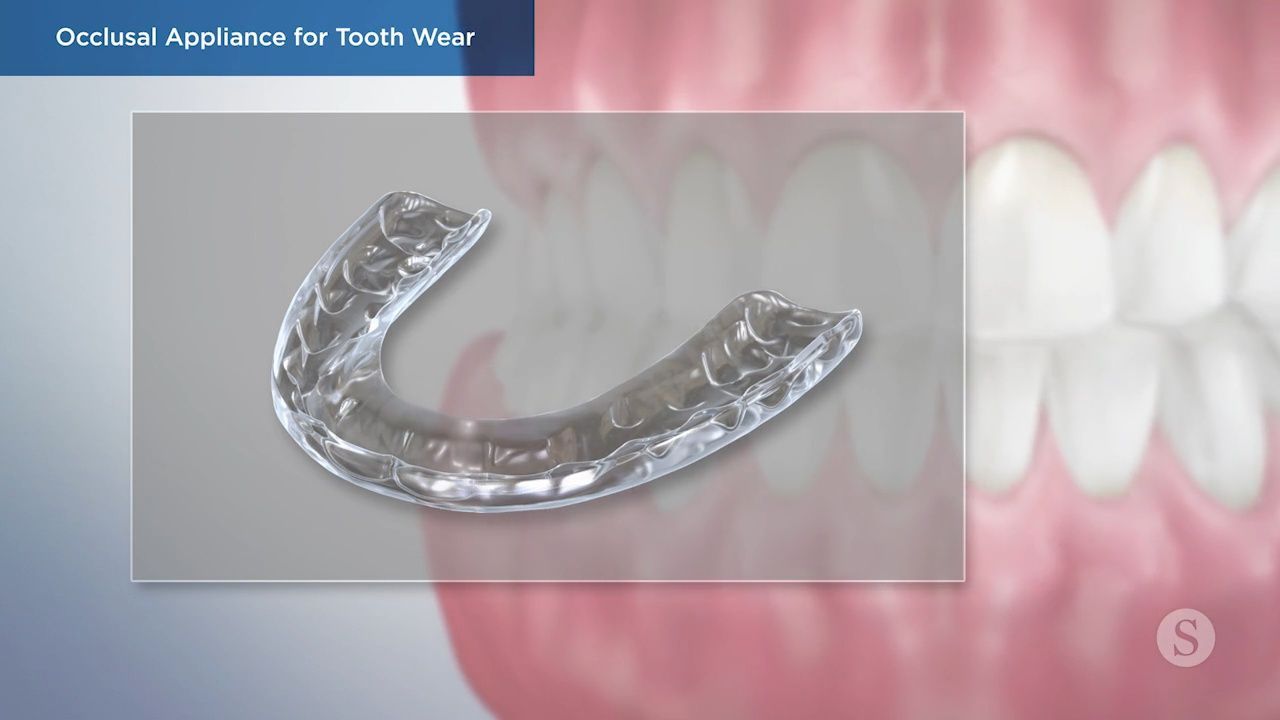 Clear dental appliance for tooth wear protection