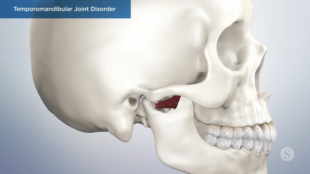 Anatomy of temporomandibular joint disorder explained.