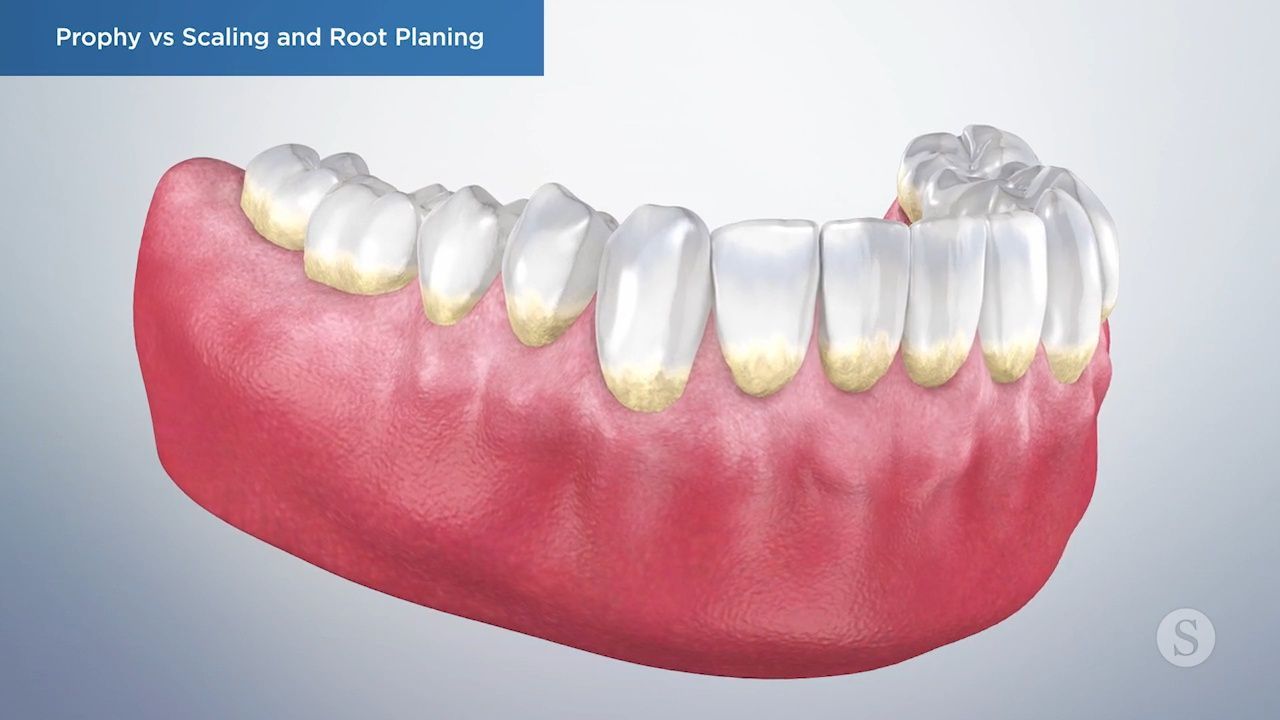 Comparison of dental cleaning techniques and procedures.