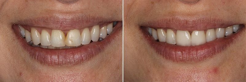 360 degree Veneers Before and after images