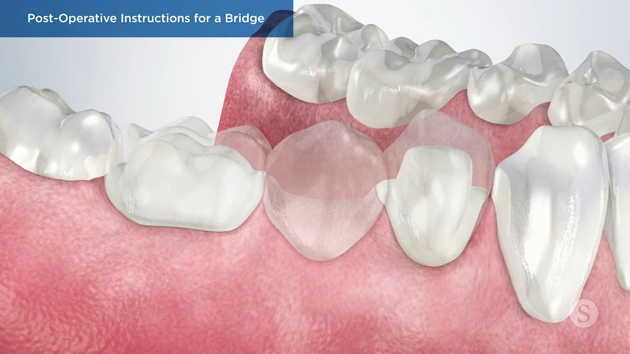 Anterior composite filling dental procedure illustration.