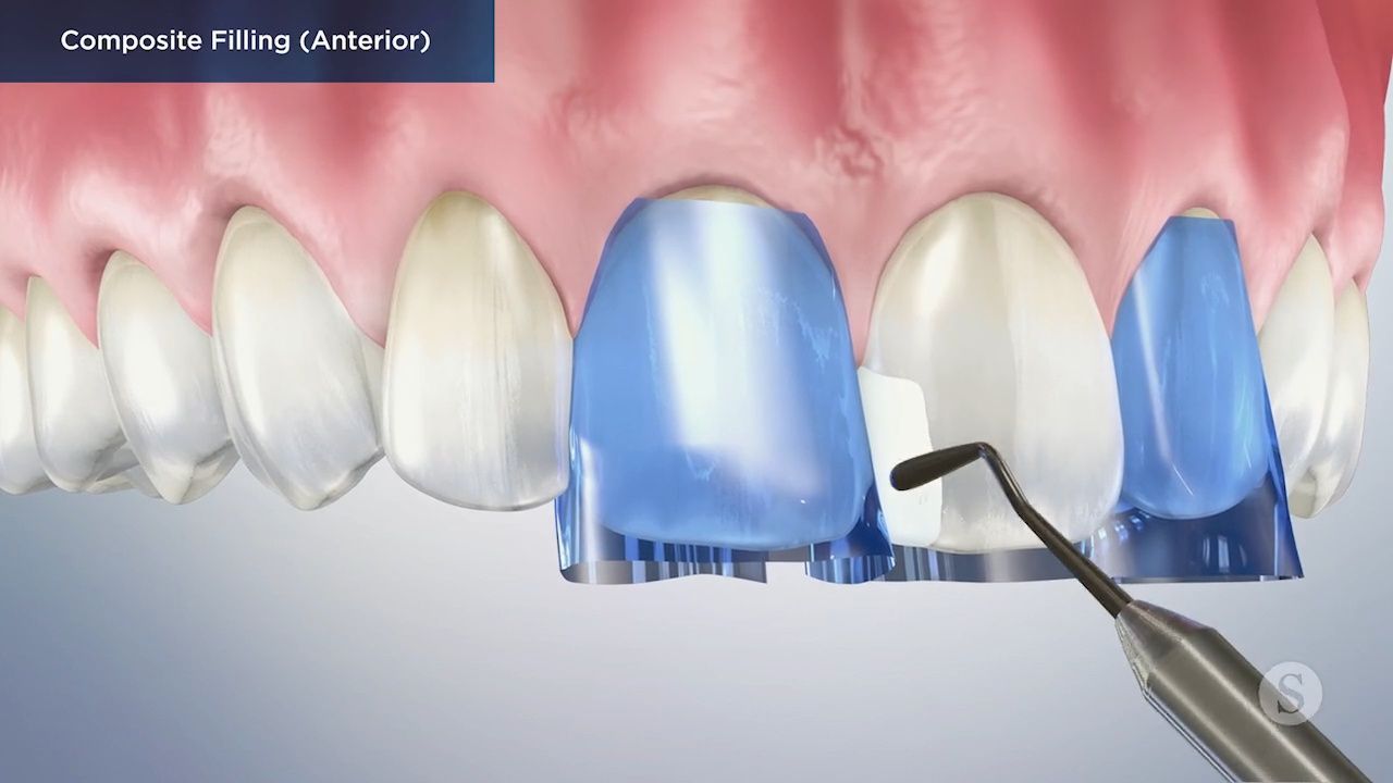 Anterior composite filling dental procedure illustration.